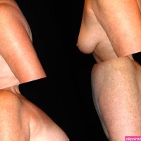 Fat Transfer to the Breast Archives